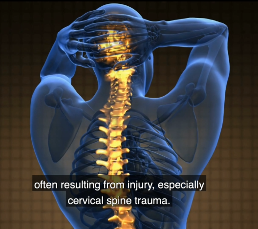 How bioelectronic technologies can help patients with Fibromyalgia